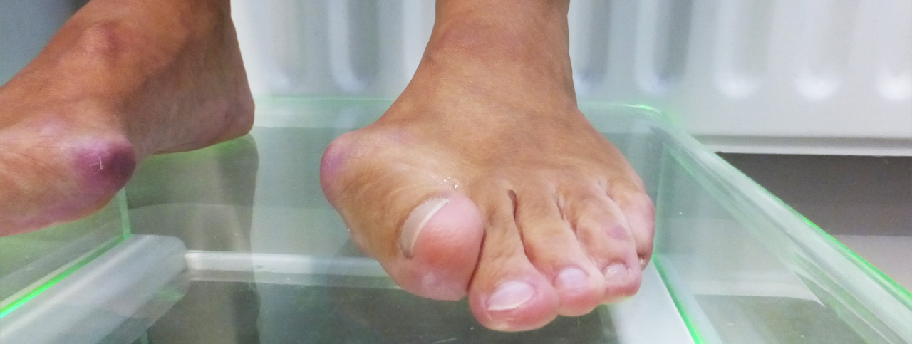 Een bult bij de grote teen (hallux valgus)